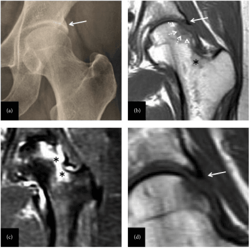 Radiograph and MRI of the hip showing acetabular overcoverage and marrow signal change