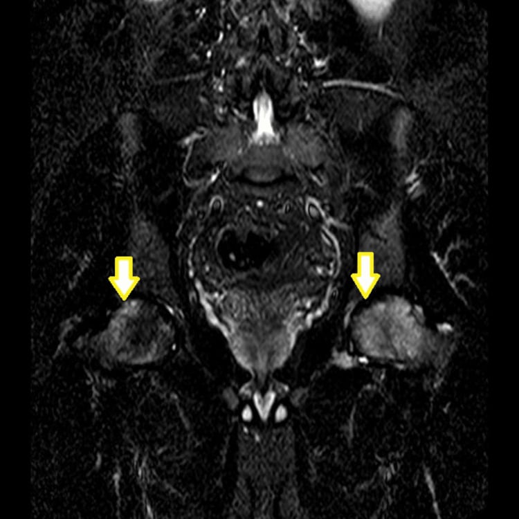 Coronal STIR MRI of the pelvis showing extensive high-signal bone marrow oedema