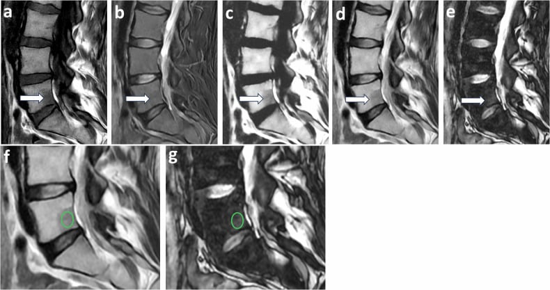 MRI comparing focal marrow hyperplasia with metastasis