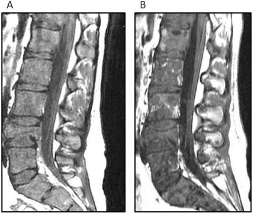 Sagittal STIR MRI showing extensive osseous metastases with pathologic fractures