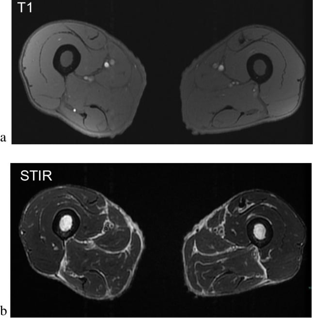 T1 and STIR MRI showing diffuse marrow change in serous atrophy from rapid weight loss