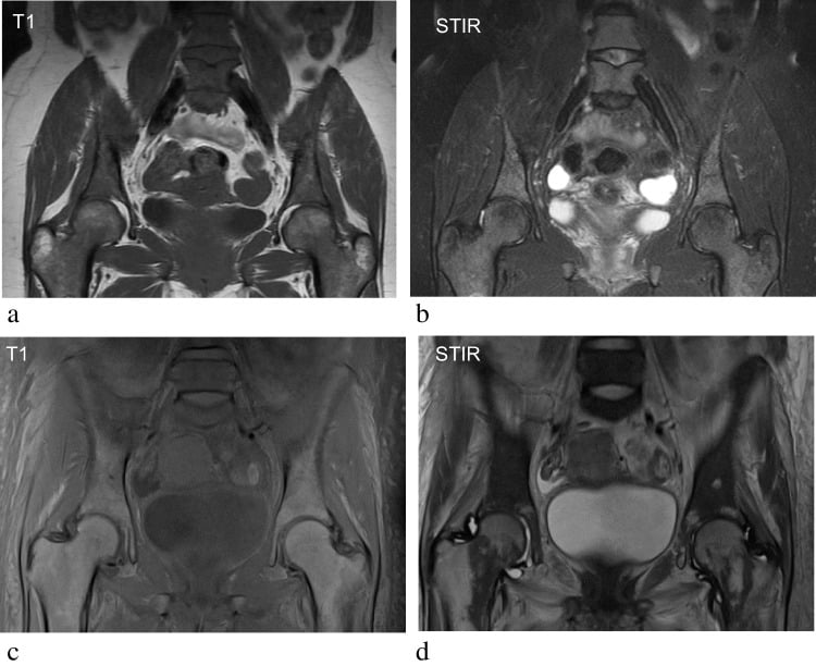 Sagittal T1 MRI showing diffuse hypointense reconversion in sickle cell disease