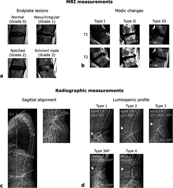 Diagram and MRI of endplate lesion types and Modic changes