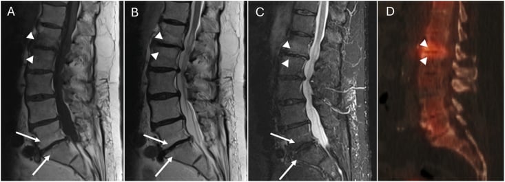 Sagittal MRI and SPECT-CT showing partial discordance in vertebral marrow signal