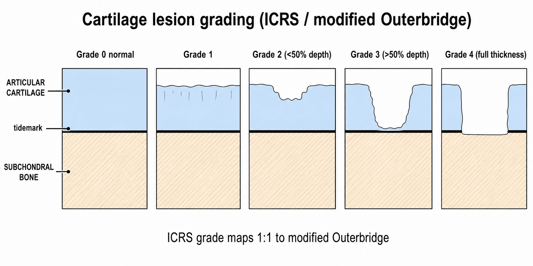 Schematic of cartilage lesion grades 0 to 4 showing increasing defect depth through the cartilage to the subchondral bone