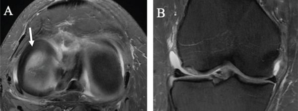 Axial and coronal knee MRI showing an osteochondral impaction defect of the lateral femoral condyle with marrow oedema.