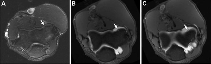 Conventional MRI and MR arthrography of a capitellar osteochondral lesion showing contrast undermining an unstable fragment.