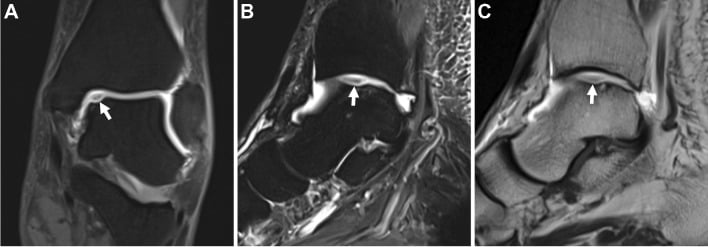 Coronal, sagittal and MR arthrographic ankle images showing an unstable medial talar-dome osteochondral lesion.