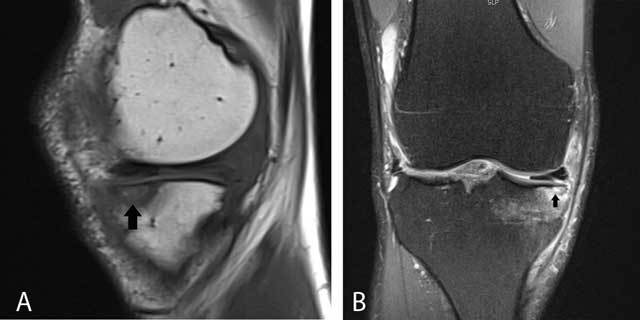 Sagittal T1-weighted and coronal fat-suppressed T2-weighted knee MRI showing a subchondral stress fracture with surrounding marrow oedema.