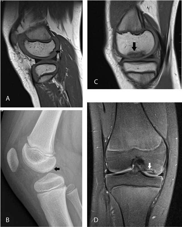 Paediatric radiographs and MRI comparing a normal femoral-condyle ossification variant with osteochondritis dissecans.