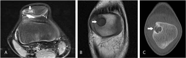 Axial and coronal knee MRI with cone-beam CT showing a dorsal patellar defect beneath intact articular cartilage.