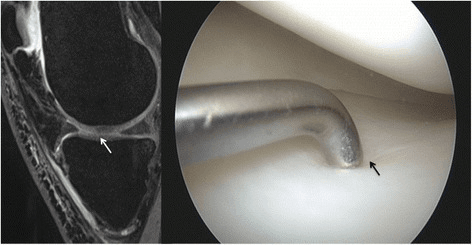 Sagittal fat-suppressed knee MRI and the corresponding arthroscopic image of a low-grade chondral lesion
