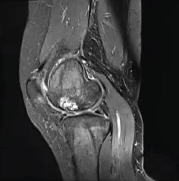 Sagittal, coronal and axial knee MRI showing a medial femoral-condyle osteochondral defect with subchondral cysts and marrow oedema.