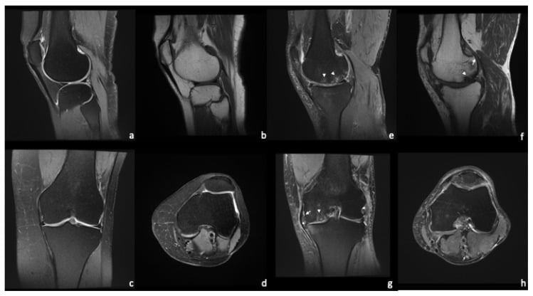 Multisequence knee MRI comparison of healthy cartilage and severe medial-compartment osteoarthritis.