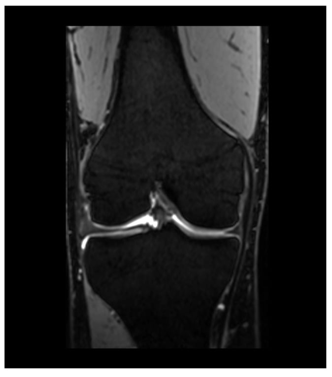 Coronal dual-echo steady-state MRI showing high-resolution articular cartilage surfaces of the knee.