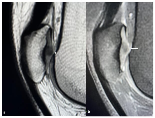 Matched sagittal proton-density and fat-suppressed proton-density MRI showing patellar cartilage chondropathy.