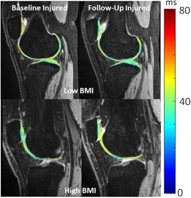 Colour-coded sagittal T1rho maps of knee cartilage at baseline and follow-up in injured knees.