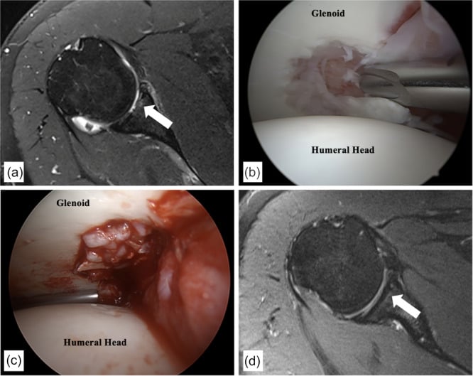 Preoperative and follow-up shoulder MRI with arthroscopic views before and after minced cartilage implantation of an anterior glenoid defect.