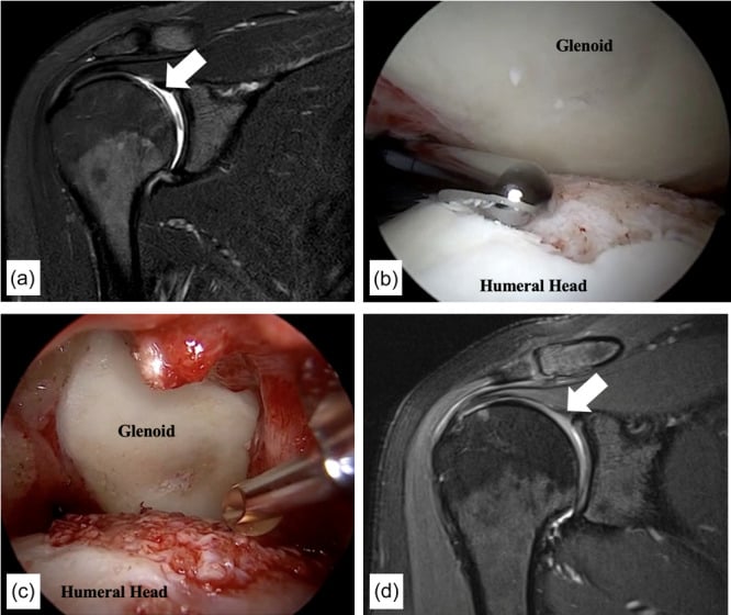 Coronal shoulder MRI and arthroscopic images showing a humeral-head cartilage defect before and after minced cartilage implantation.