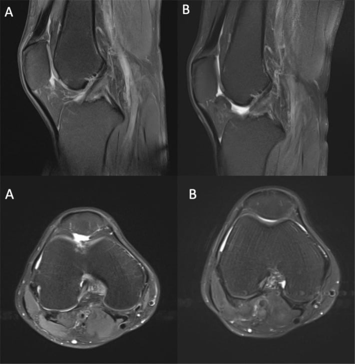 Baseline and five-year sagittal and axial knee MRI showing cartilage repair tissue after scaffold implantation with microfracture.