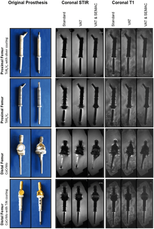 Grid comparing titanium and cobalt-chrome prostheses on coronal STIR and T1 MRI under standard, VAT and VAT&SEMAC sequences.