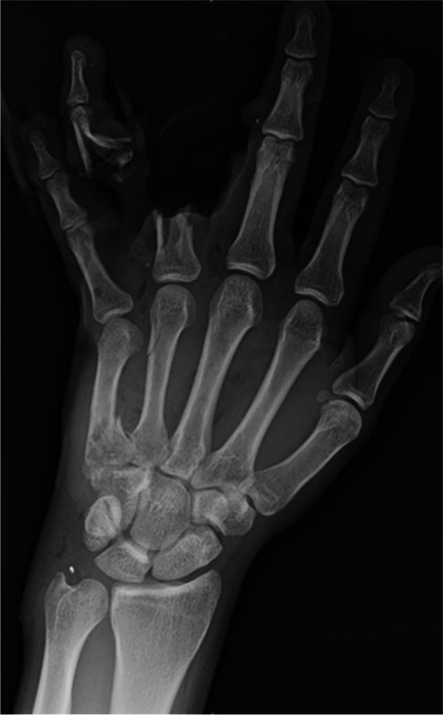 Hand radiograph showing multiple retained metallic bullet fragments after a gunshot injury.