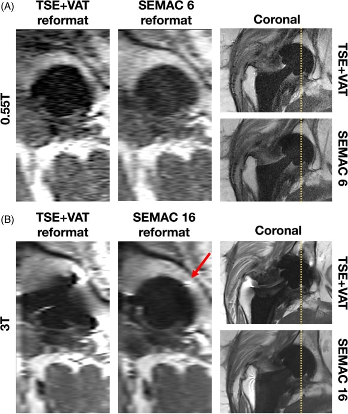 Comparison of VAT and SEMAC MRI around titanium total hip arthroplasty at 0.55 and 3 tesla.