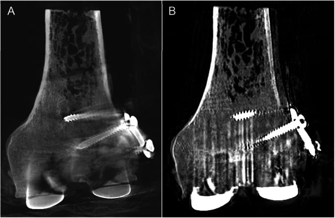 Weight-bearing and conventional CT images of fixation adjacent to a total knee femoral component.
