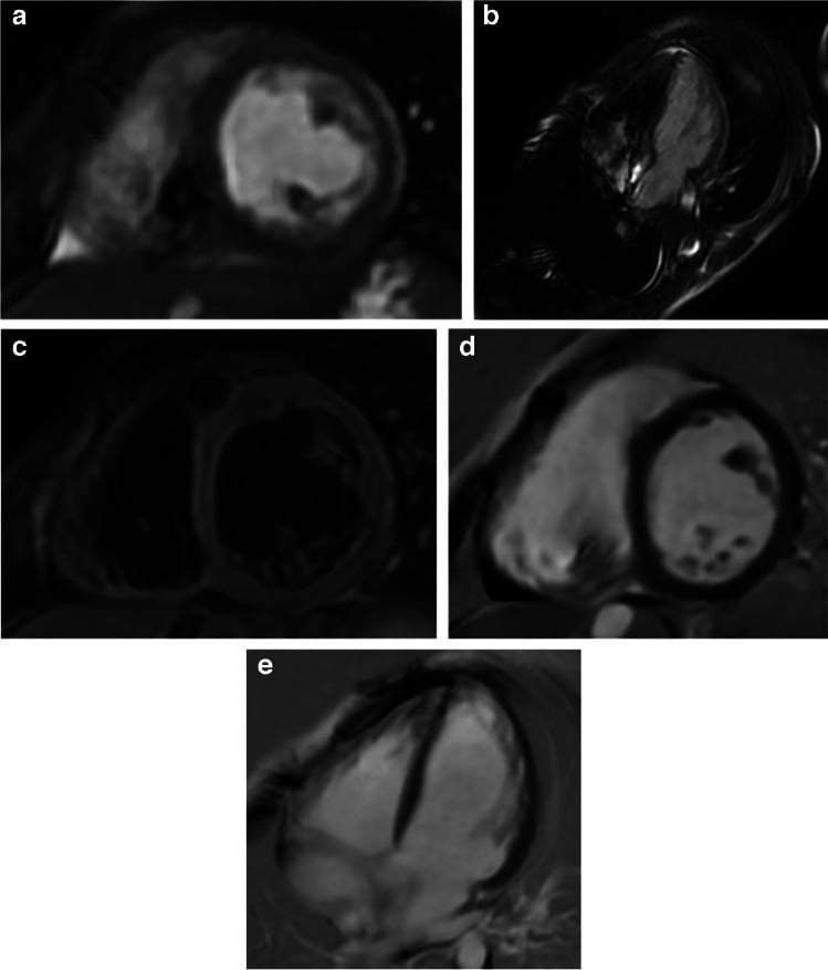 Cardiac MRI sequences showing diagnostic myocardium with local susceptibility artefact from an implanted cardiac device.