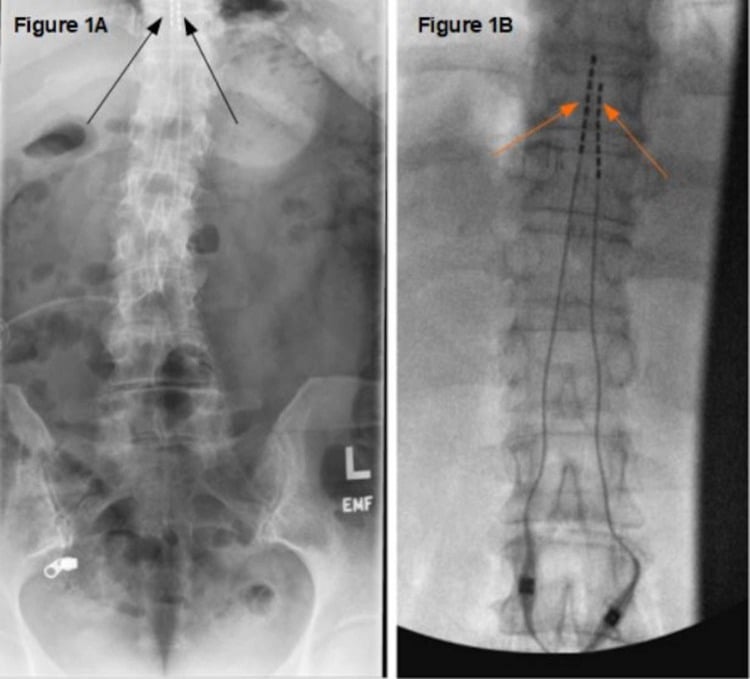 Lumbar radiographs showing spinal cord stimulator leads before and after revision.