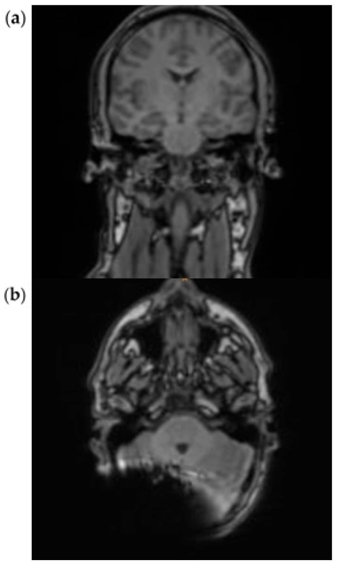 Coronal and axial 1.5-tesla HASTE MRI demonstrating the regional signal void from a cochlear implant.