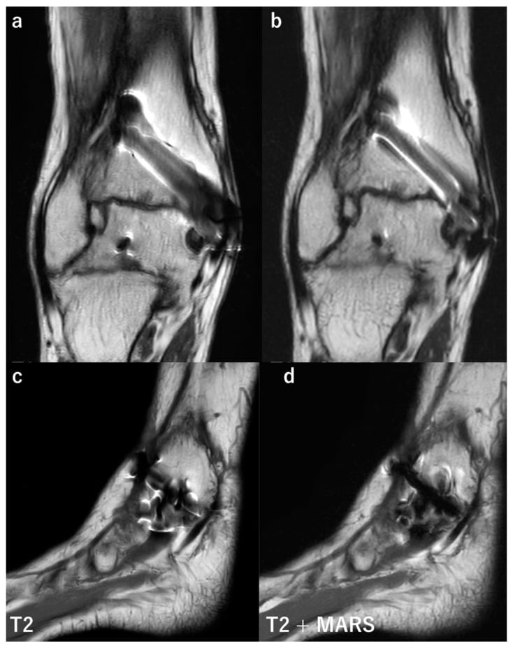 Coronal and sagittal T2-weighted MRI of the right ankle after screw fixation of a medial malleolar fracture, without MARS (a, c) and with MARS (b, d)
