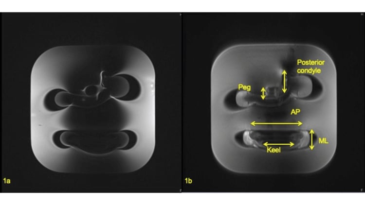 Phantom MRI of unicompartmental knee arthroplasty components at 3 T: conventional proton density (1a) and SEMAC proton density with measurement labels (1b)