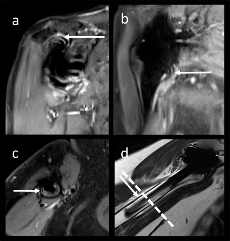 Ripple artefacts on compressed-sensing SEMAC STIR images after reverse shoulder arthroplasty (a to c), with a sagittal intermediate-weighted comparison image (d)