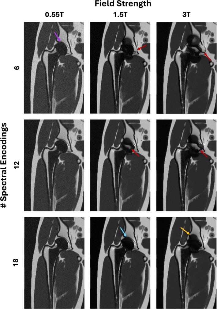 Grid of simulated hip implant MRI at 0.55 T, 1.5 T and 3 T with 6, 12 and 18 SEMAC spectral encodings