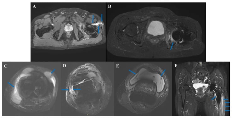 Six-panel MARS MRI characteristic findings in prosthetic joint infection