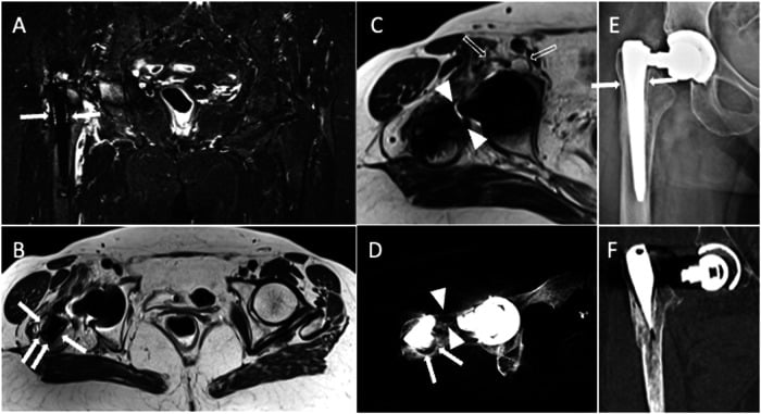 MRI, CT and radiograph of a right total hip arthroplasty with periprosthetic femoral bone resorption and implant neck disruption