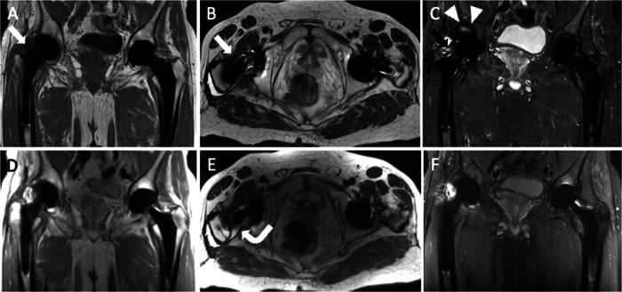 Pelvic MRI of hip arthroplasty with MARS sequences (A to C) and MAVRIC sequences (D to F)
