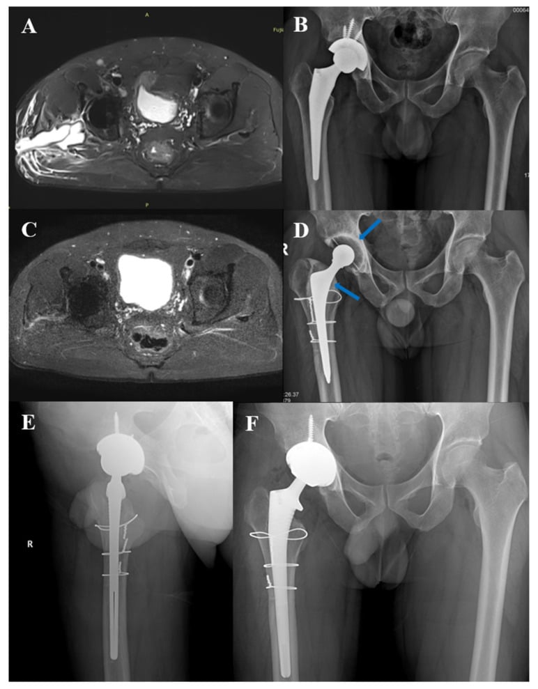 MARS MRI and radiograph comparison across a two-stage hip revision for prosthetic joint infection