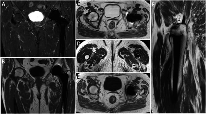 Normal pelvic MARS MRI of an asymptomatic left total hip arthroplasty: coronal STIR, coronal T1, axial T2, axial T1 and sagittal T2 images