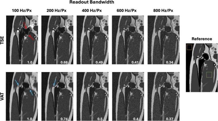 Simulated TSE and view-angle-tilting hip MRI at readout bandwidths of 100 to 800 Hz per pixel, with relative SNR printed on each image and a noiseless reference image