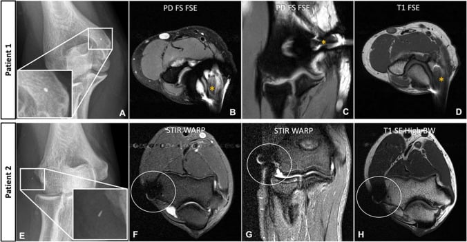 Radiographs and MRI of residual metal fragments at the distal humerus in two patients: standard PD FS FSE and T1 FSE images in patient 1, STIR WARP and high-bandwidth T1 spin-echo images in patient 2