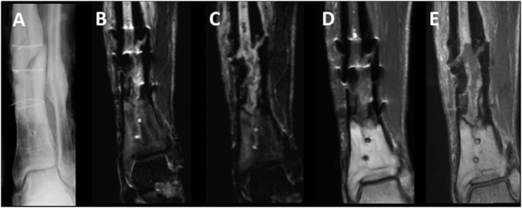 Radiograph and coronal MRI of an infected left distal tibial pseudarthrosis with retained cerclage: conventional STIR and contrast-enhanced T1 beside the same sequences with VAT and SEMAC