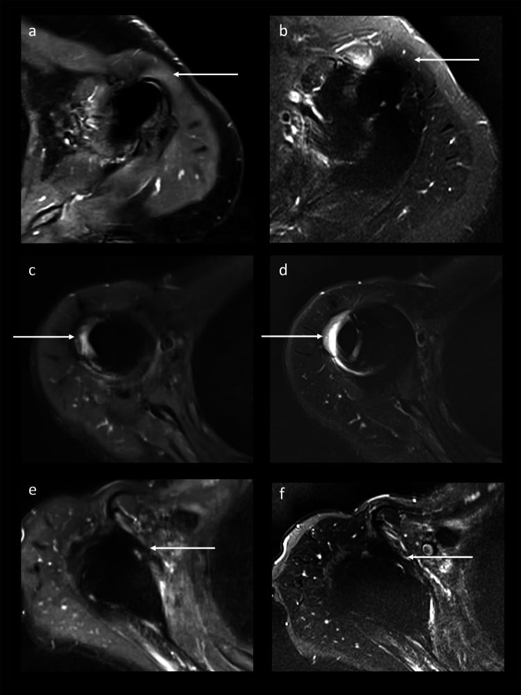 Three pairs of transverse compressed-sensing SEMAC and VAT STIR images after reverse shoulder arthroplasty (a to f)