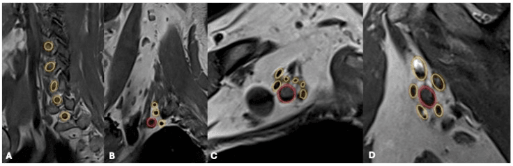 Sagittal MRI panels A to D tracing the brachial plexus from roots to terminal branches, with nerve elements outlined in yellow and the axillary artery in red