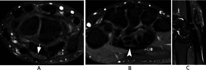 MRI panels A to C showing proximal enlargement and distal flattening of the median nerve