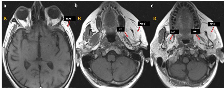 T1 MRI panels a to c showing chronic fatty atrophy of the muscles of mastication, with labelled muscles