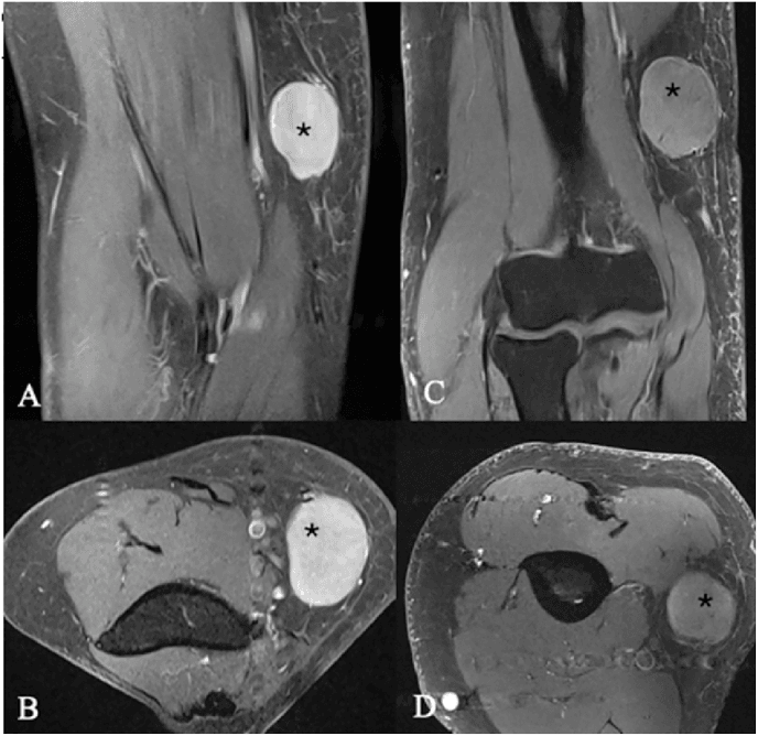 MRI panels A to D of an intraneural lymphoma, a mass marked with an asterisk, mimicking a peripheral nerve sheath tumour