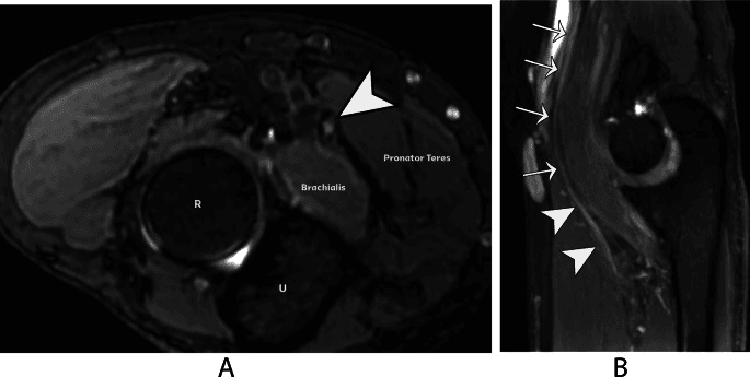 MR neurography panels A and B showing median nerve enlargement in lacertus syndrome