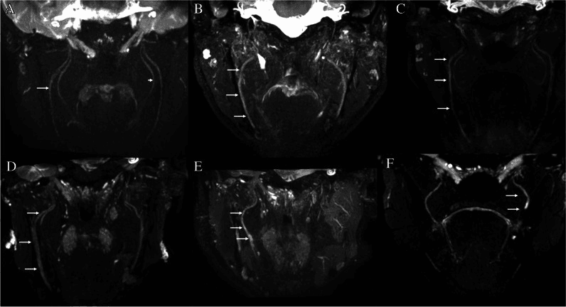 MR neurography panels A to F with arrows marking injured nerves